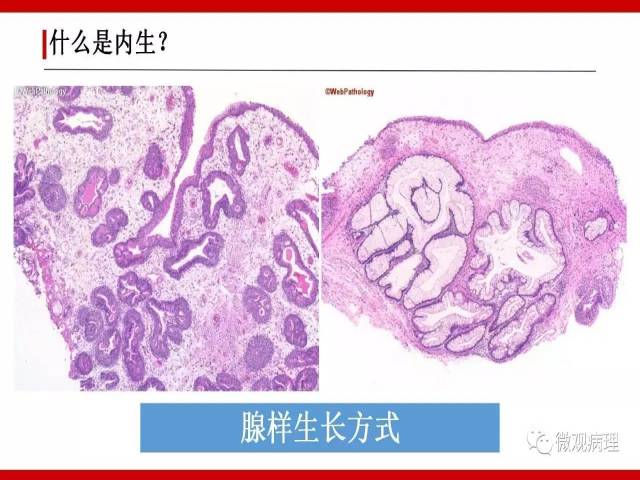 泌尿课程/尿路上皮病变的基本生长方式