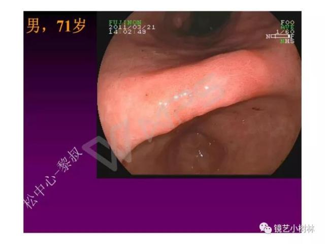 上消化道早癌病理的学习心得体会（附胃牵手癌的病例特点文献学习）