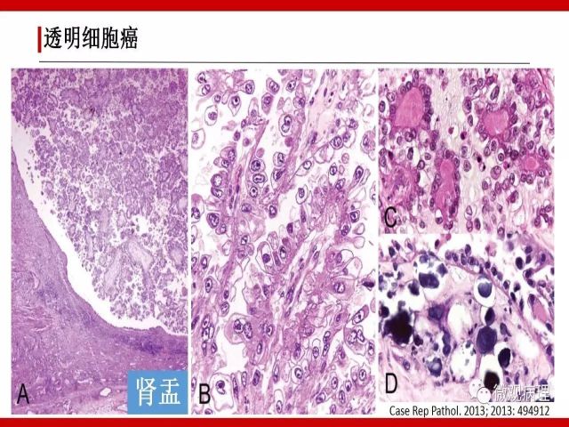 泌尿课程/尿路腺样病变的诊断要点
