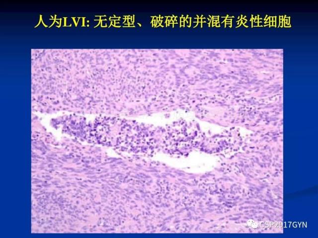 子宫内膜癌：诊断与进展