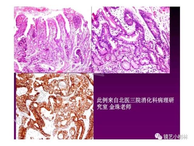 上消化道早癌病理的学习心得体会（附胃牵手癌的病例特点文献学习）