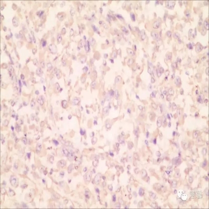 甲状腺癌乳头状癌伴未分化癌（肉瘤样癌）分化