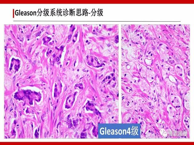 前列腺癌Gleason分级系统的前世今生