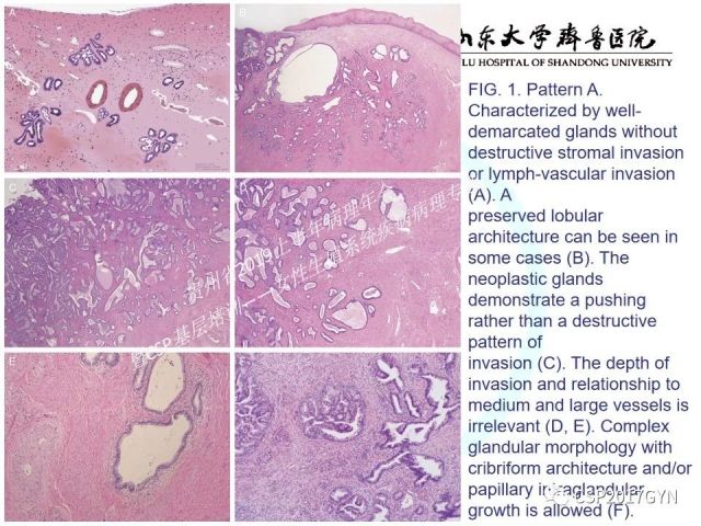 中华病理学会基层培训遵义站讲座（四）——宫颈腺癌的诊断及新分型