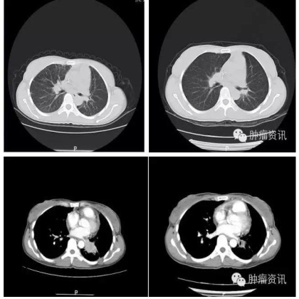中日韩个体化诊疗案例大赛经典赏析之十二——胸水细胞RT-PCR检测ALK融合，更高效识别突变患者