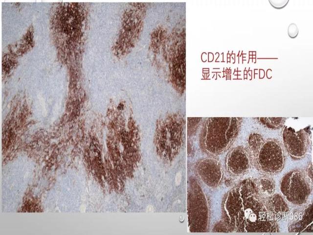血管免疫母T细胞淋巴瘤的病理诊断