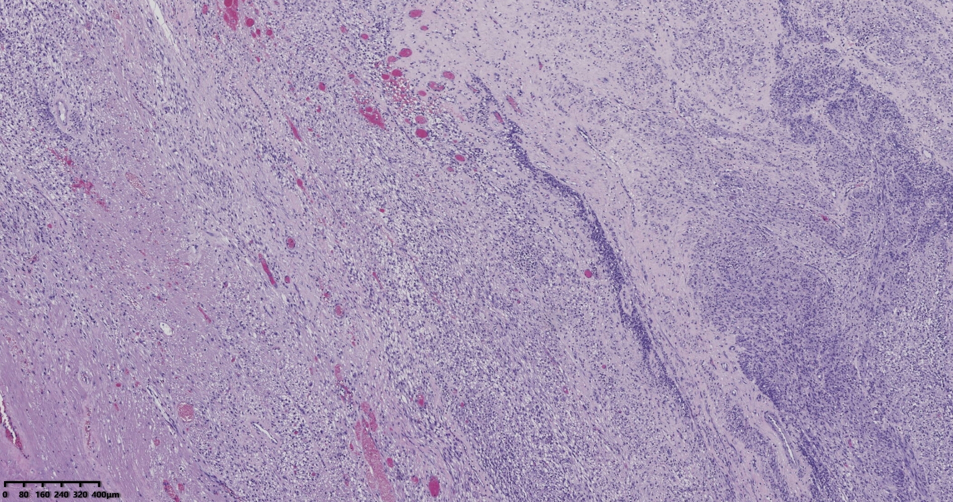 子宫多发性平滑肌瘤伴肉瘤