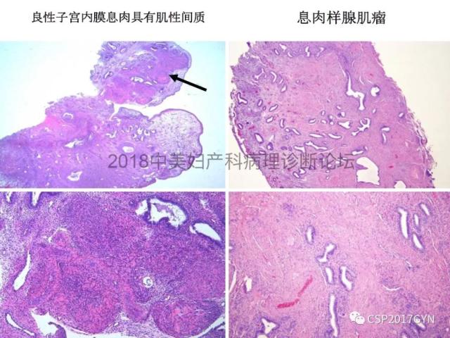 子宫内膜假肿瘤性病变及类似癌样病变