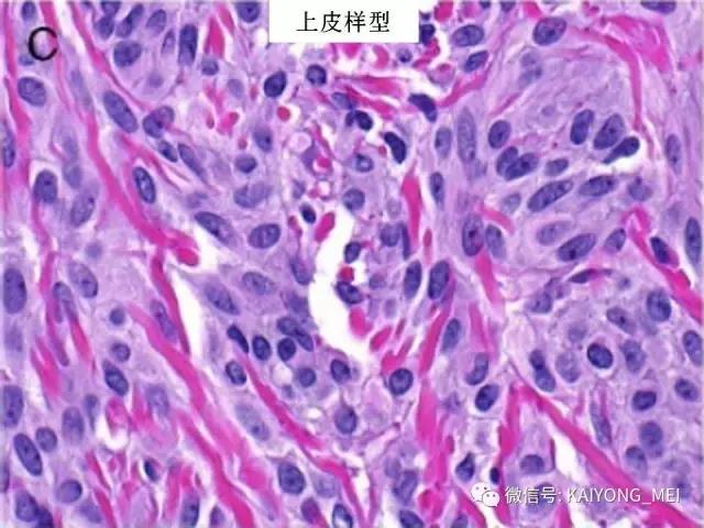 乳腺梭形细胞病变的病理诊断及进展（一）