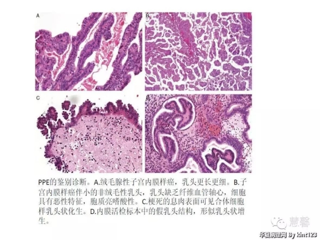 子宫内膜乳头状增生（甜甜分享病例，孔祥田(Max)*Roswell*老师讲解，kent翻译整理文献）