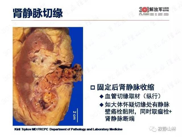 泌尿系统常见肿瘤标本病理报告规范
