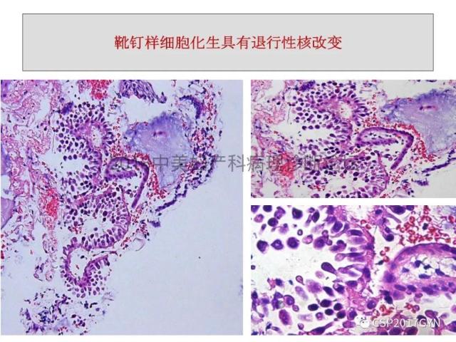 子宫内膜假肿瘤性病变及类似癌样病变