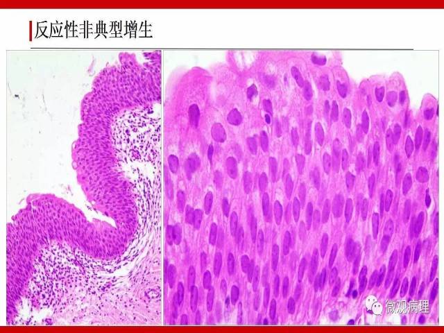 膀胱尿路上皮肿瘤诊断的一些困惑