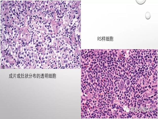 血管免疫母T细胞淋巴瘤的病理诊断