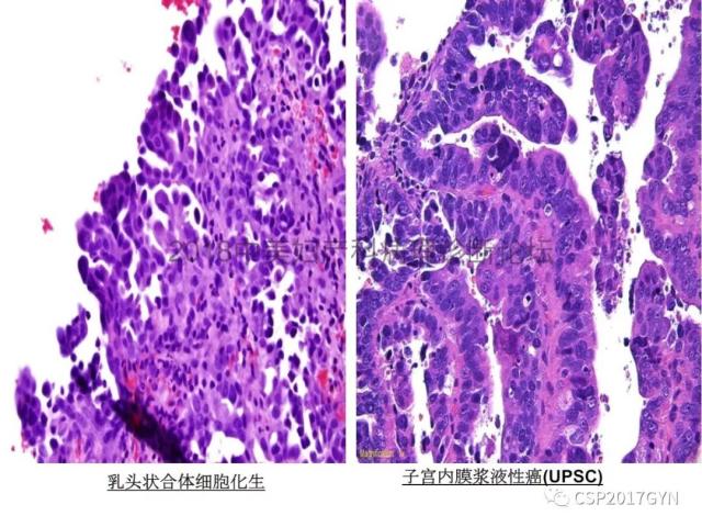 子宫内膜假肿瘤性病变及类似癌样病变