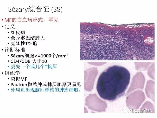 皮肤T细胞淋巴瘤