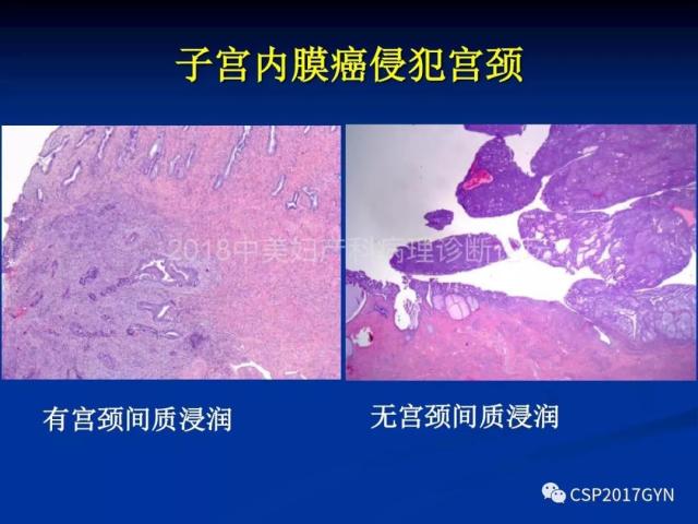 子宫内膜癌：诊断与进展