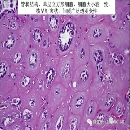卵巢癌的病理诊断新进展（三）