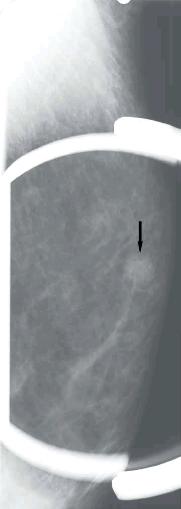 病史是病理医生的有力武器：ER阳性肺腺癌转移至乳腺一例