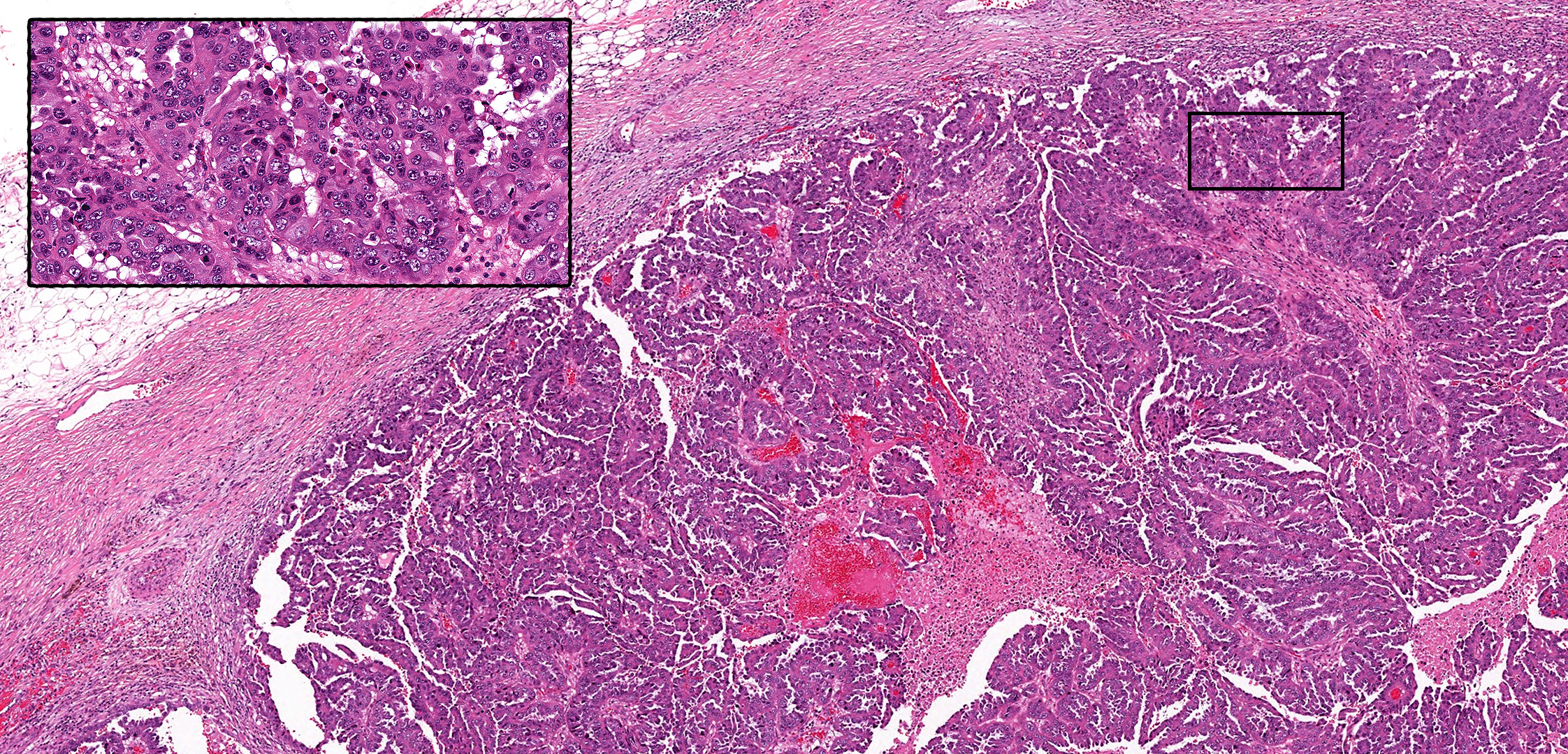 读文献,学病理-乳腺乳头状肿瘤难点总结(二) 读文献,学病理-乳腺乳头状肿瘤难点总结(二)