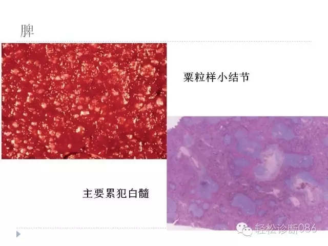慢性淋巴细胞性白血病