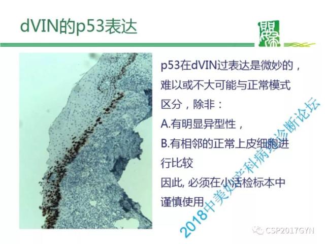 非HPV相关的外阴鳞状细胞肿瘤