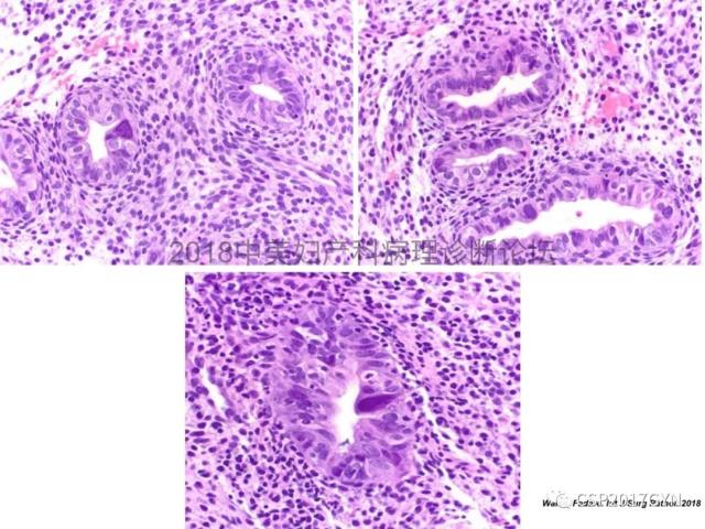 子宫内膜假肿瘤性病变及类似癌样病变