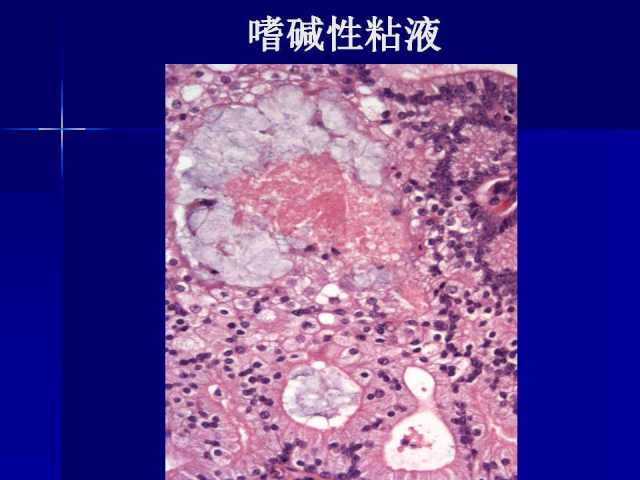 前列腺病理诊断线索（上）——黄教悌