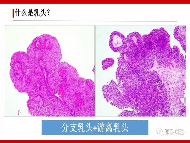 泌尿课程/尿路上皮病变的基本生长方式