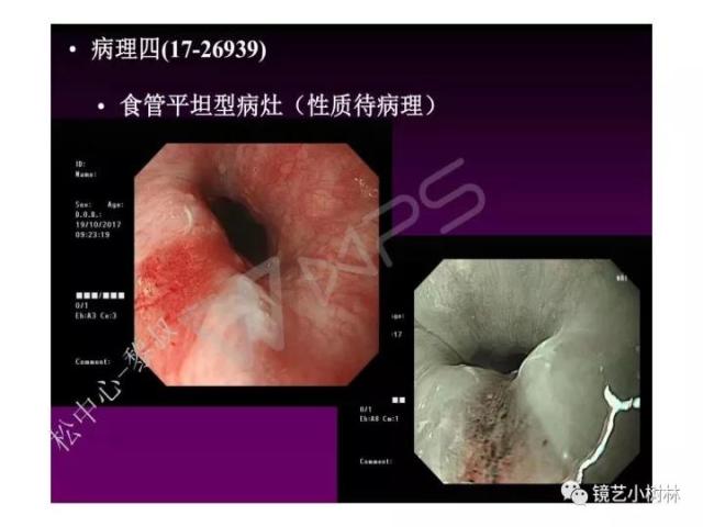 上消化道早癌病理的学习心得体会（附胃牵手癌的病例特点文献学习）