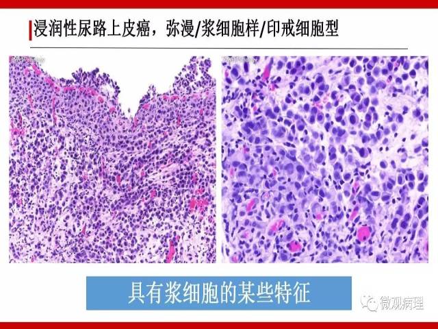 泌尿课程/浸润性尿路上皮癌病理学类型