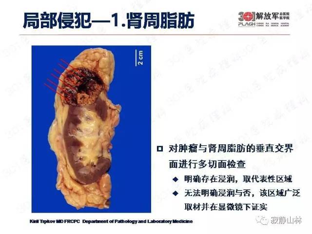泌尿系统常见肿瘤标本病理报告规范