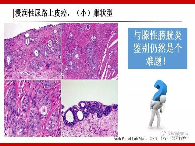 泌尿课程/浸润性尿路上皮癌病理学类型