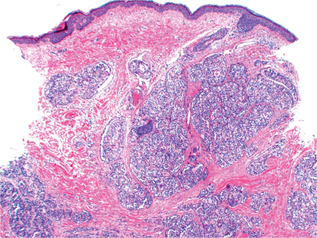 【投稿】文献赏析：70岁女性腹部质实结节一枚