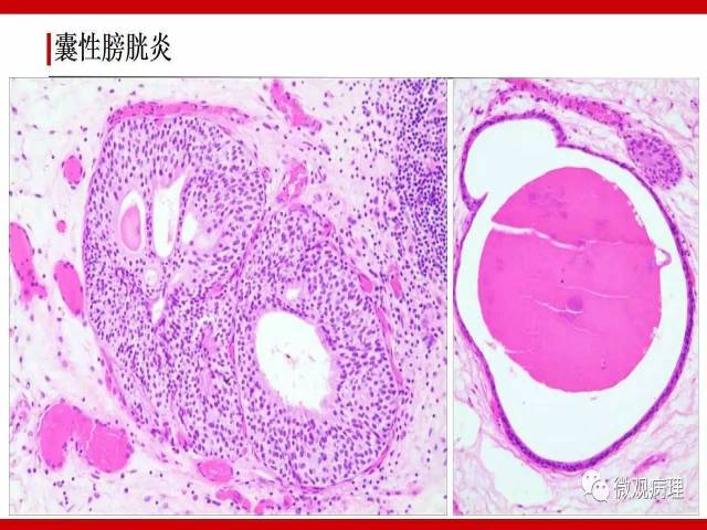 膀胱尿路上皮肿瘤诊断的一些困惑