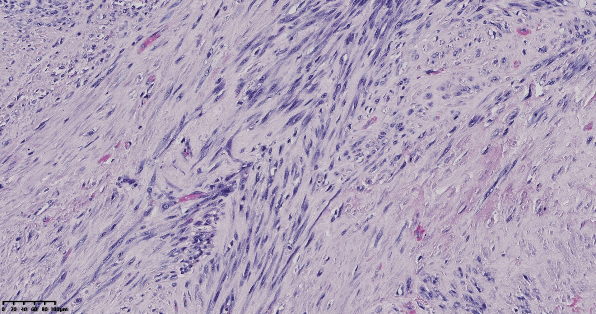 子宫多发性平滑肌瘤伴肉瘤