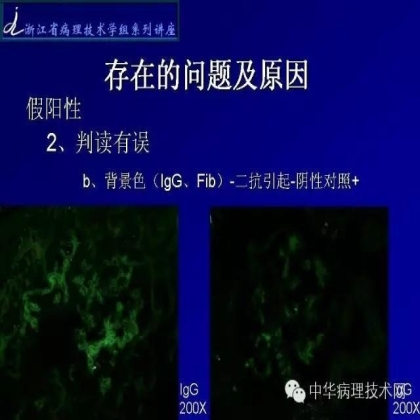 探讨免疫组织学在肾穿标本中的应用