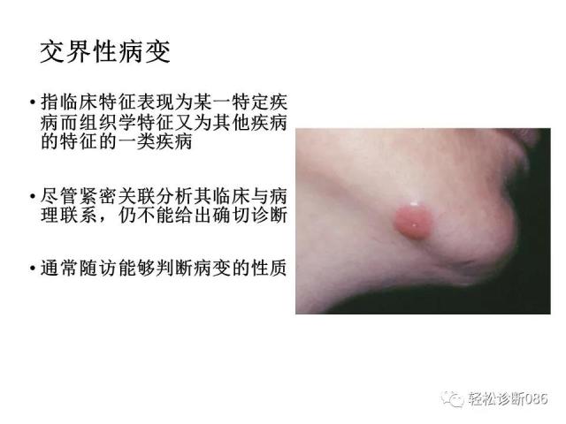 皮肤T细胞淋巴瘤