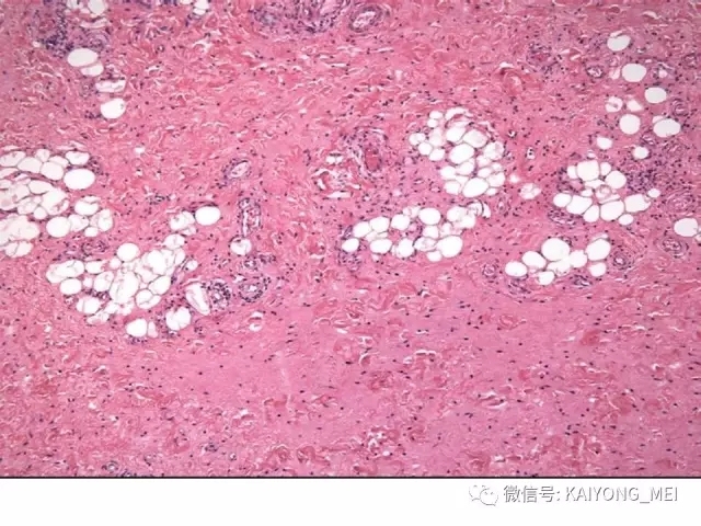 女性生殖道软组织肿瘤病理诊断及进展（一）