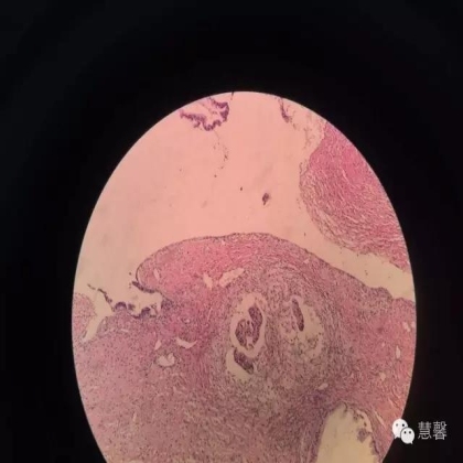 交界性黏液性囊腺瘤？癌？（魏娉分享，刘从容老师讲解）