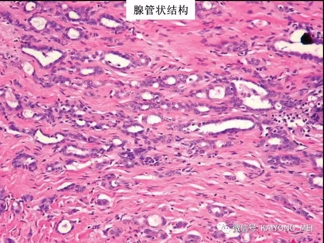 卵巢癌的病理诊断新进展（一）