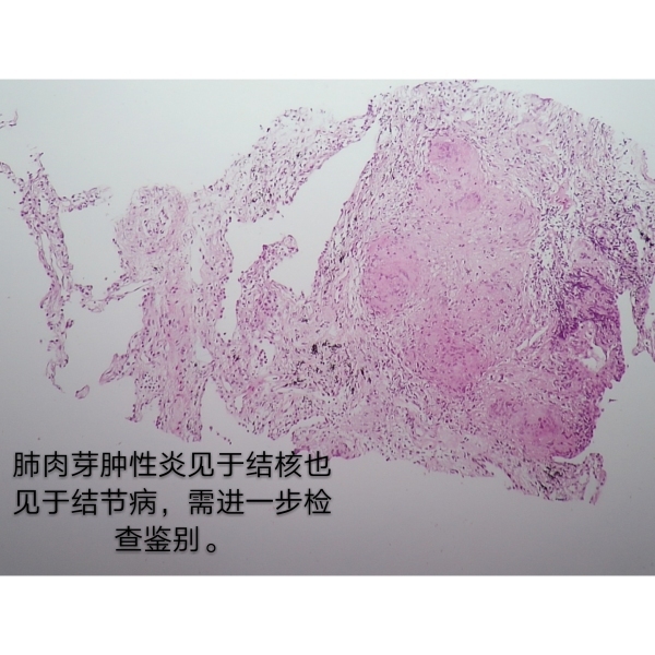 病理科工作札记（四十）举例细说四类病理诊断