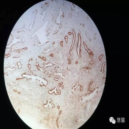 子宫腺肉瘤【吴梅娟】分享；【刘从容】老师讲解）
