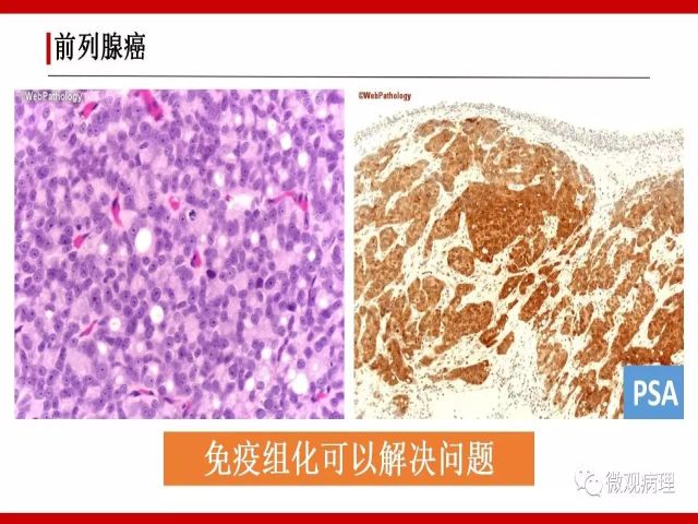 泌尿课程/尿路腺样病变的诊断要点
