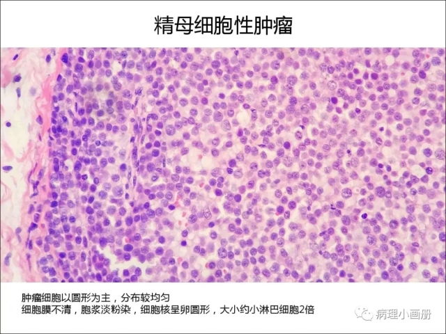 泌尿病理--精原细胞瘤VS精母细胞瘤