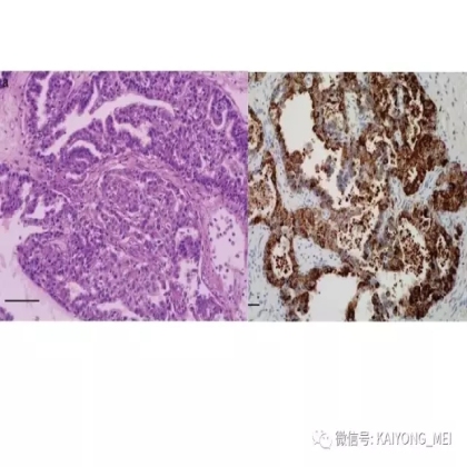 卵巢癌的病理诊断新进展（三）