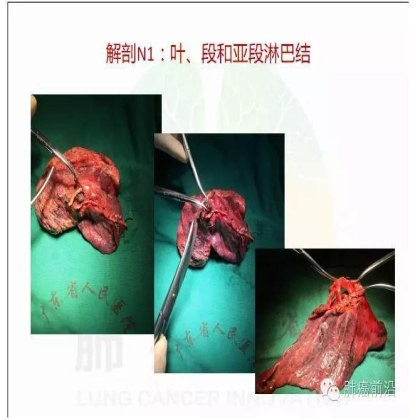肺癌新分期和分类--临床和研究启示