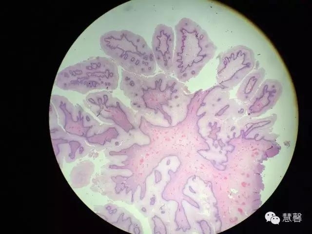 阴道鳞状上皮乳头状瘤？尖锐湿疣？（孔祥田老师病例分享，粉蓝医疗科技（杭州）有限公司女性生殖2群讨论，孔祥田(Max)*Roswell*老师讲解）