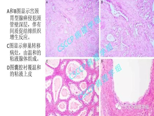 宫颈胃型腺癌中输卵管黏膜受累
