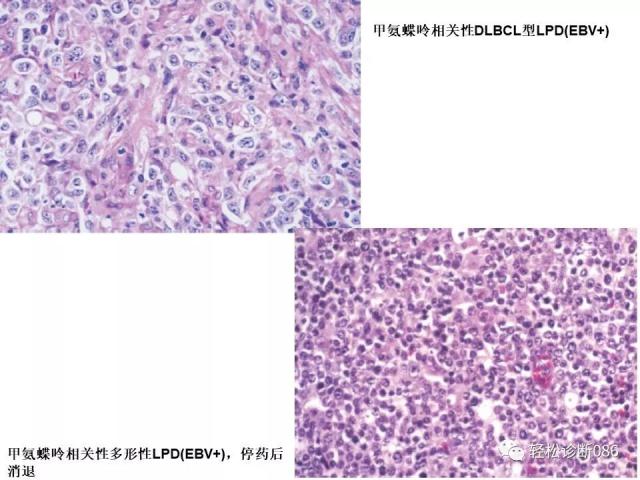 免疫缺陷相关淋巴组织增殖性疾病